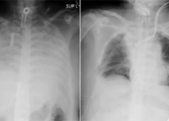 pulmonary tuberculosis causes symptoms and treatment 133579