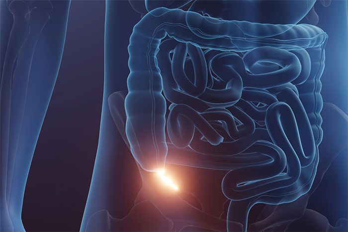 If your appendix is about to rupture, you still need to have it removed.