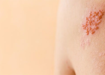 shingles symptoms causes and treatment 98007