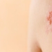 shingles symptoms causes and treatment 98007