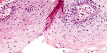 signs of chickenpox and prevention methods 82412