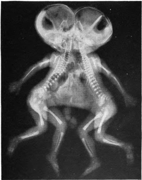 An X-ray image of conjoined twins in 1954.