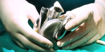 the first person in the world to live many days with a titanium heart 135929