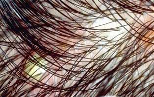 Itchy rash on the scalp