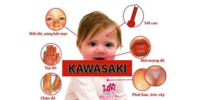 Some symptoms of children with Kawasaki.