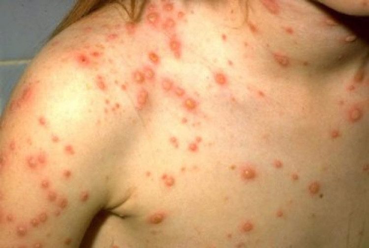 Blisters appear rapidly within 12 - 24 hours in individuals with chickenpox.