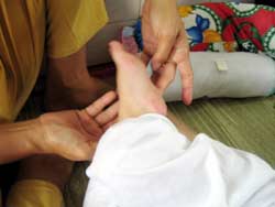 Blisters on the foot of a child being treated for hand, foot, and mouth disease at Children's Hospital 1.