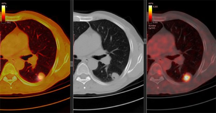 PET CT Scanning helps detect primary tumors and metastatic tumors.