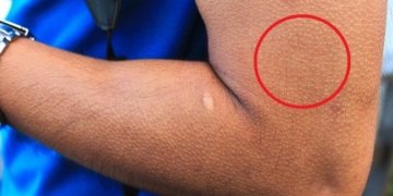 decoding the phenomenon of skin itching 90533