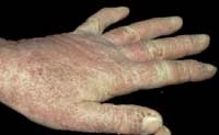 disease skin inflammation due to insect contact 5031