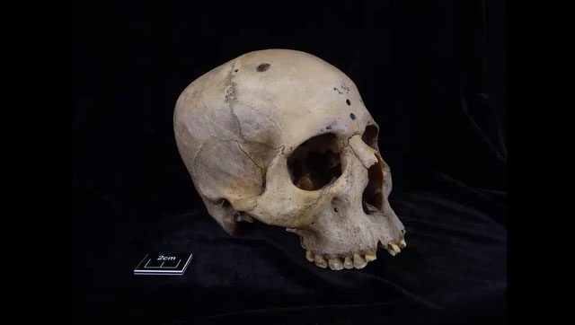  The skull of an ancient Egyptian shows signs of surgery