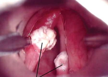 invention test diagnosis 12 types of cancer 4480