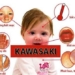 kawasaki disease causes symptoms and treatment 116257