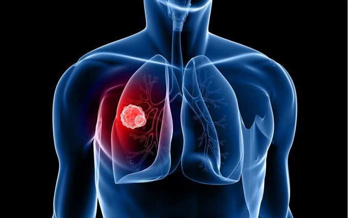 Illustration of lung cancer tumor.