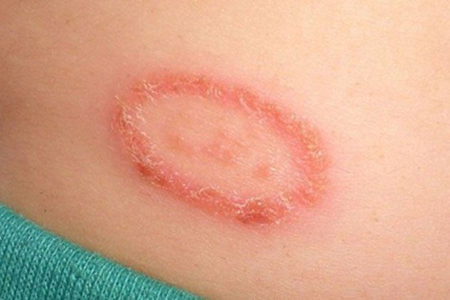 Tips to prevent Paederus stings