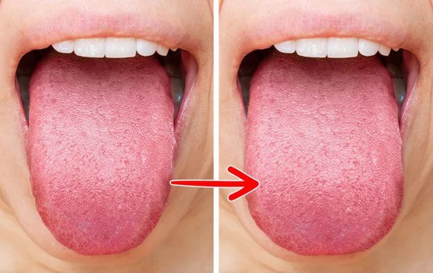 Your tongue can become enlarged