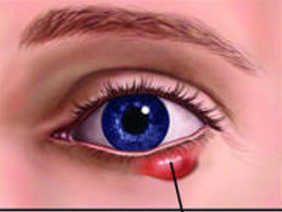 Chalazion