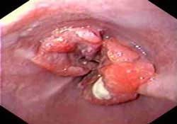 nac cut coi chung bi ung thu 5036