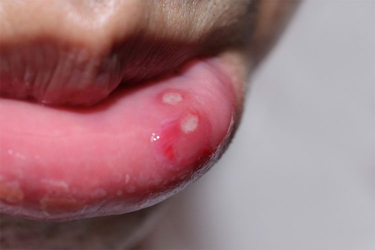 One or more white spots measuring 1 - 2 mm appear on the oral mucosa.