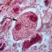 pneumonia panicillium marneffei an indicator of aids 4956