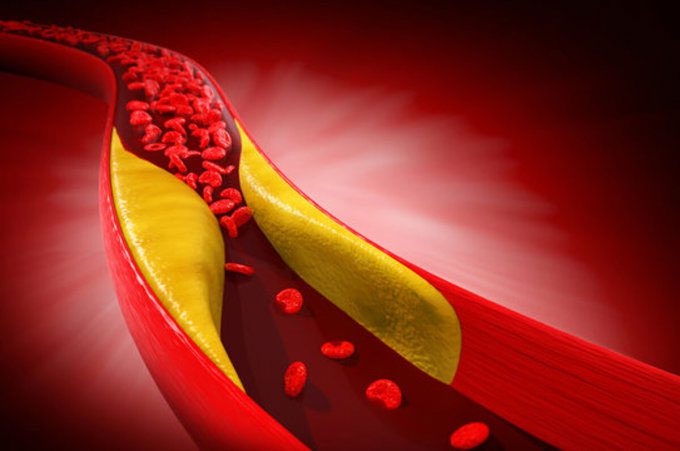 Simulation of artery blockage due to high cholesterol