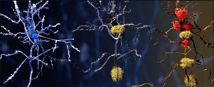 Healthy brain cells, Alzheimer’s-affected cells, and cells "drowned" by microglia