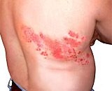 the first symptom of hemorrhoids 4512