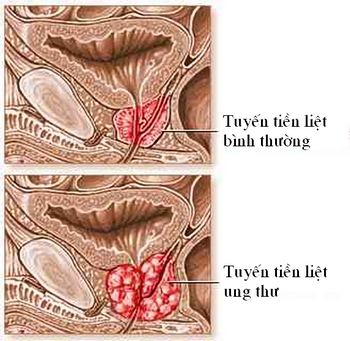 Comparison of Normal and Cancerous Prostate