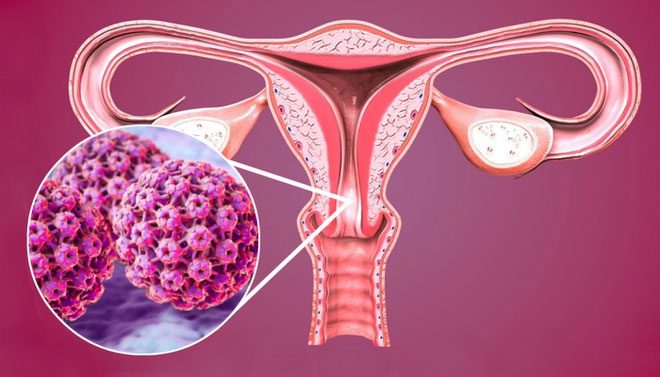 Most cervical cancer patients have a history of HPV infection.