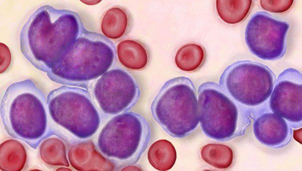 What You Need to Know About Blood Cancer