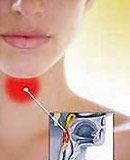 Location of pharyngitis