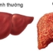 what is liver cirrhosis who is most affected 94526