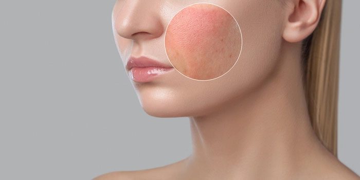 Windburn is a condition where the skin loses its natural oil layer due to wind and becomes easily irritated.