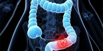 breakthrough in early detection of colon cancer tumors 132422