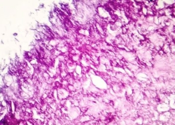 find a way to eliminate 99 cancer cells 132060