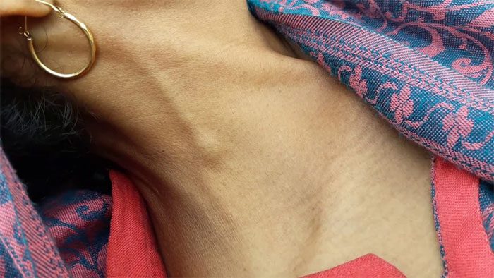 Jugular vein distension is the bulging of veins in the neck