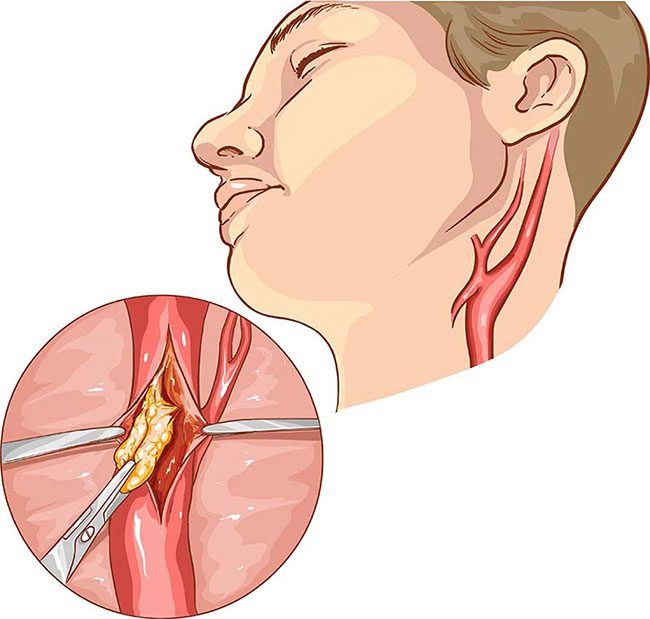 Carotid artery stenosis occurs when this artery (in the neck) becomes obstructed.