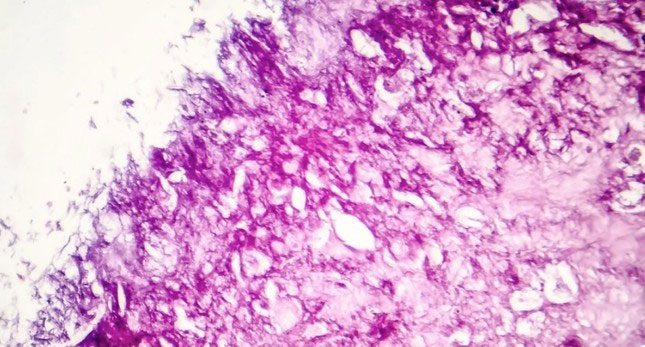 Using near-infrared light to vibrate molecules can destroy 99% of cancer cells.