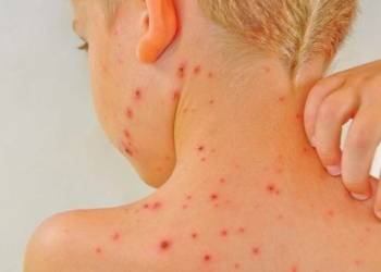 lupus map disease dangerous rarely known 67377