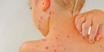 lupus map disease dangerous rarely known 67377