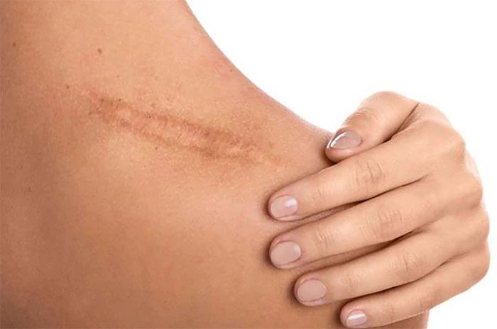 The formation of scars depends on the body's healing process.