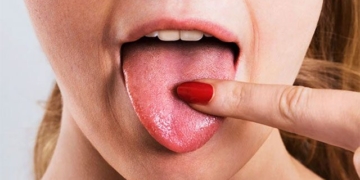 what are the causes of thrush in the mouth 132230