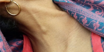 what is vasospasm is this condition dangerous 131864