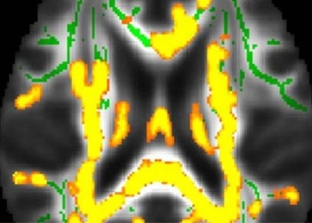 abdominal warning alzheimer disease 131246