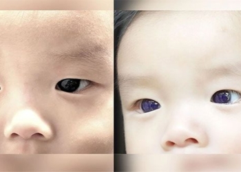 after covid 19 treatment baby changes from brown to green eyes 129728