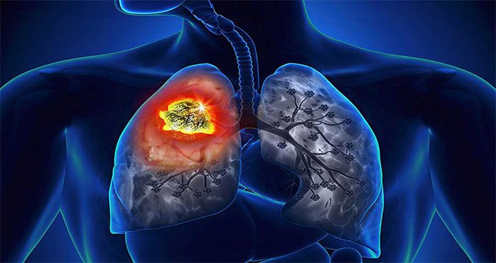 Silicosis is a lung condition caused by inhaling silica dust