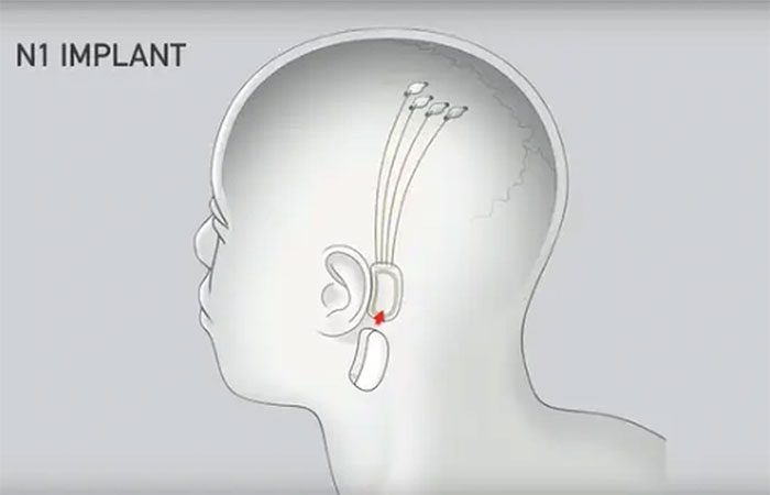 The chip will be placed behind the ear and connected with wires to electrodes touching the brain.