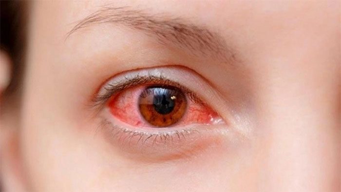 Conjunctivitis does not spread by looking into the eyes of an infected person.