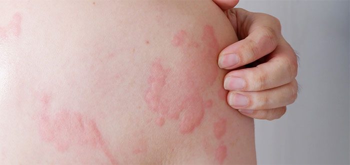 Allergy is a complex process involving multiple factors.