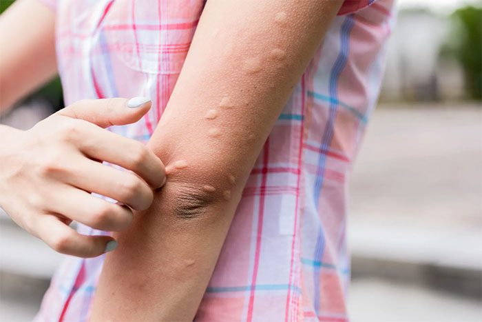 It is essential to know what you are allergic to.
